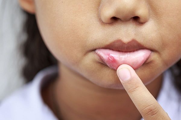 درمان آفت دهان و لثه کودکان