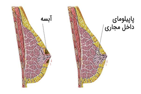 آبسه پستان در شیردهی