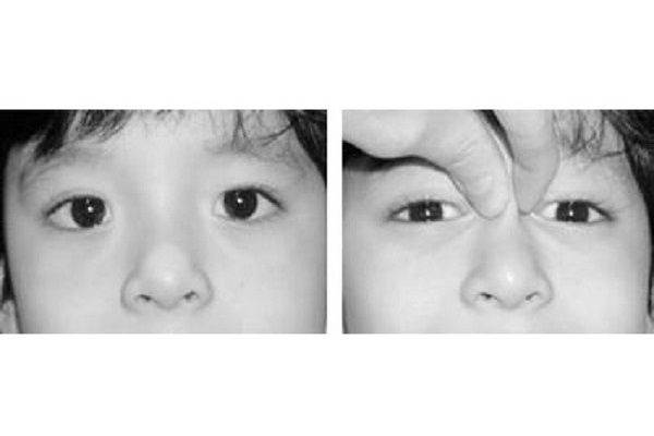 انواع انحراف چشم در کودکان