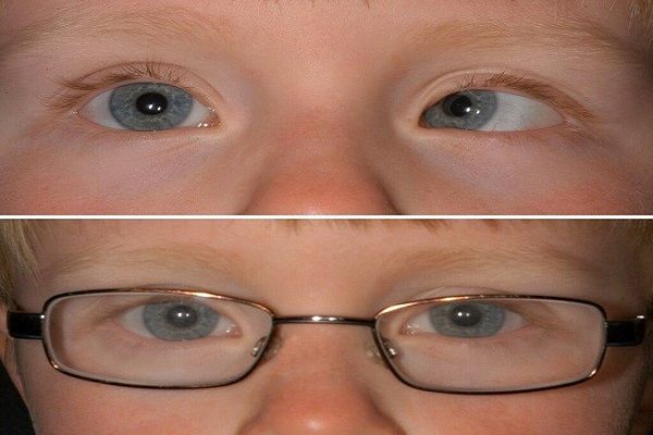 تفاوت انحراف چشم با تنبلی چشم
