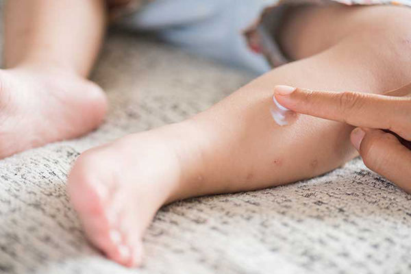 درمان پشه گزیدگی در نوزادان