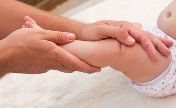 درمان کجی مچ پای نوزاد