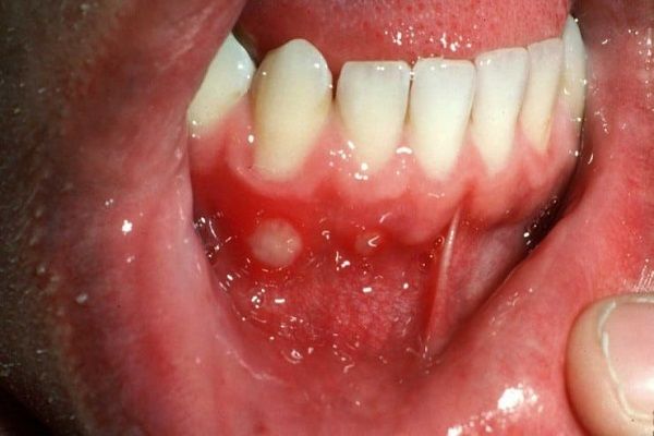 12 روش درمان آفت دهان و لثه کودکان | گهواره