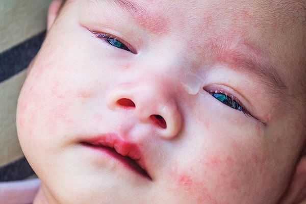 عوارض بیماری کاوازاکی در کودکان را بدانید