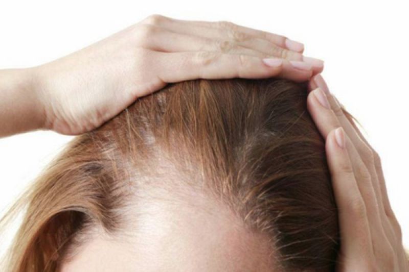 درمان ریزش مو در شیردهی