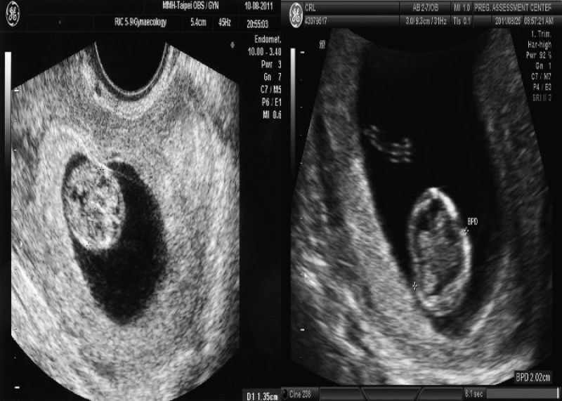  تعیین سن بارداری با سونوگرافی