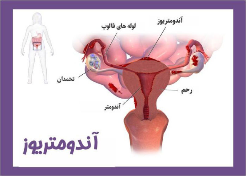 آندومتریوز چیست؟/ اندومتریوز در بارداری چیست؟