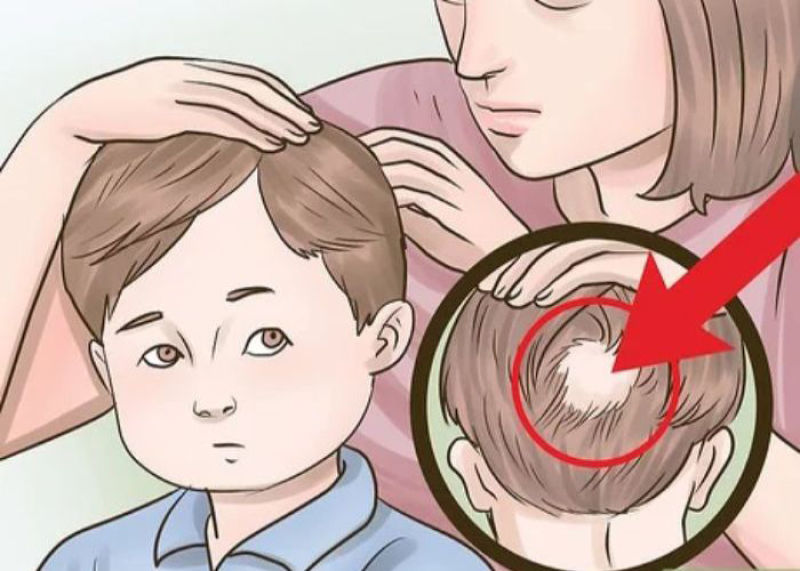 عمده‌ترین علل ریزش مو در کودکان