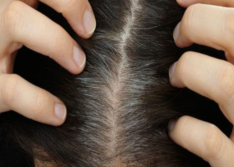 آموزش رعایت بهداشت در مورد شپش