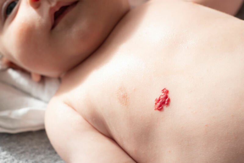 درمان همانژیوم پوستی نوزاد