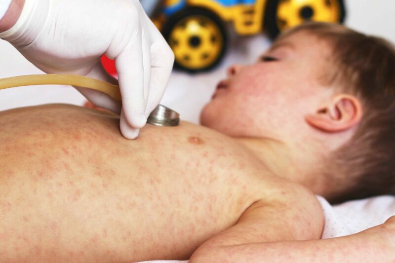 علائم ویروس بیماری روزئولا در کودکان