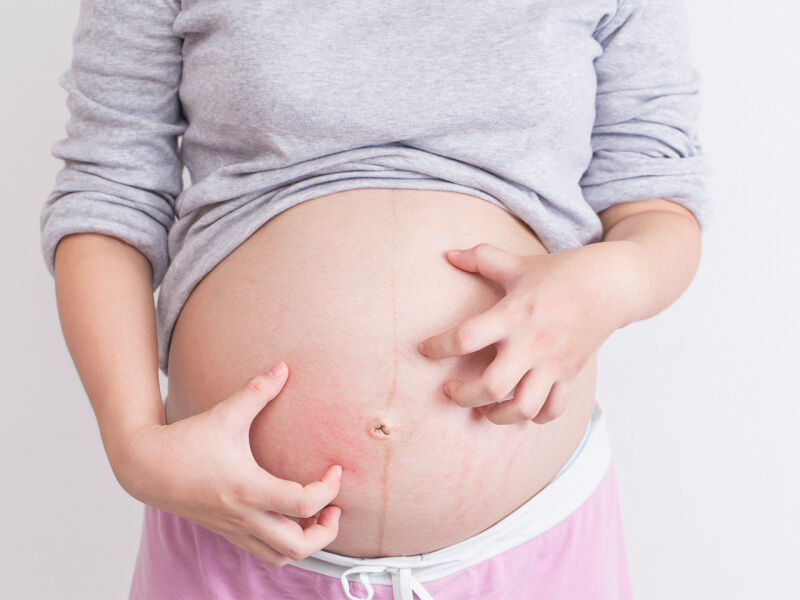 خارش ناف در بارداری