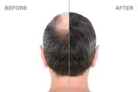 مراقبت های قبل و بعد از کاشت مو چیست؟